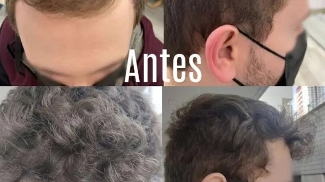 Consulta de injerto capilar