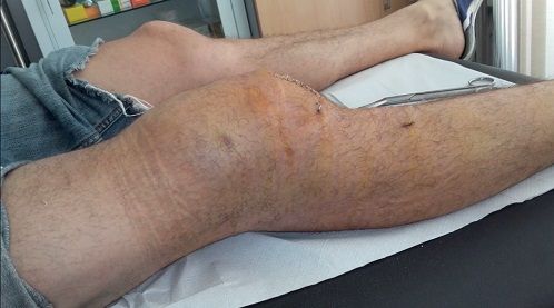 mi rodilla con un hemartros