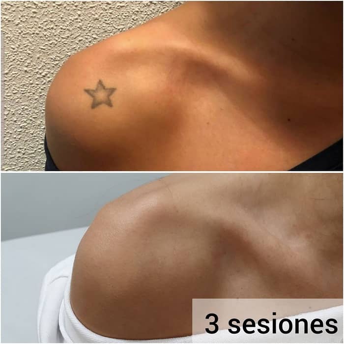 eliminacion tatuaje lasser tatto madrid antes despues