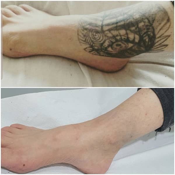 eliminacion tatuajes antes despues