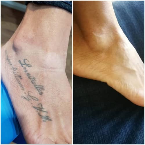 eliminar antes despues lasser tatto