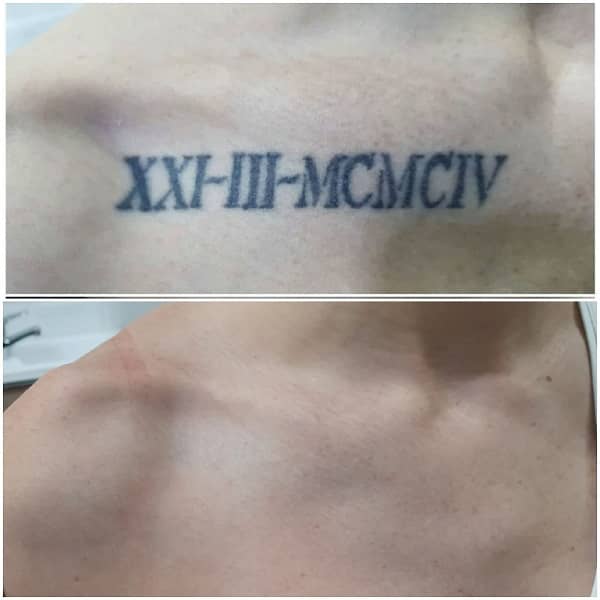 eliminar tatuajes antes despues