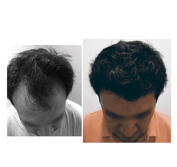 antes y despues injerto capilar madrid capilclinic