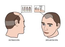 capilclinic-clinica-referente-injerto-capilar-diagrama