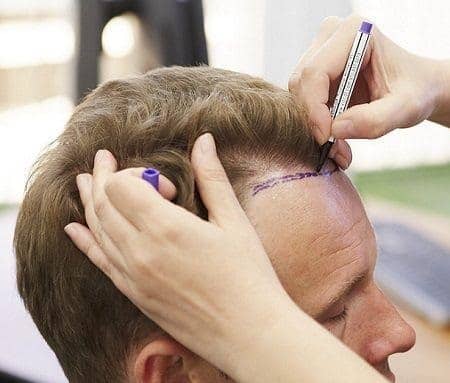 corporacion capilar dermatologica clinica capilar injerto