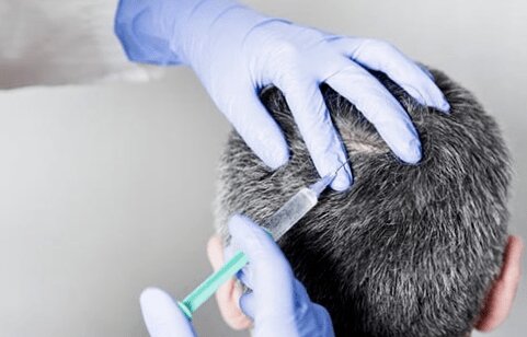 clinica mesoterapia capilar murcia