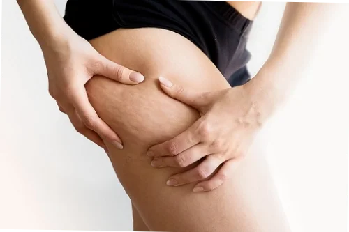 clinicas carboxiterapia Madrid