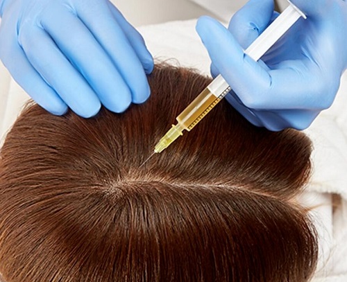 mesoterapia capilar sevilla