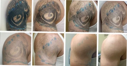 eliminar tatuajes alicante