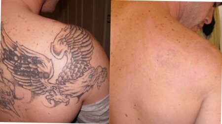 eliminar tatuajes en sevilla