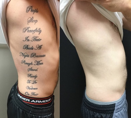 eliminar tatuajes en valencia
