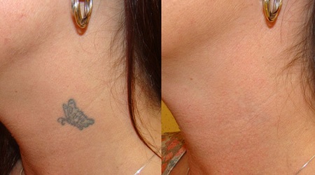 eliminar tatuajes granada