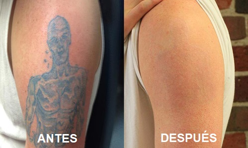 eliminar tatuajes murcia
