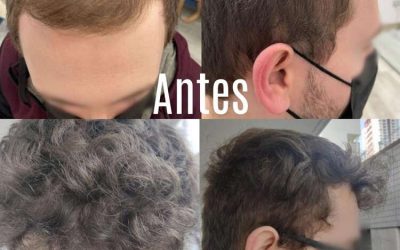 Mejores clínicas de injerto capilar en Madrid