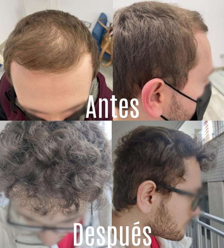 Consulta de injerto capilar