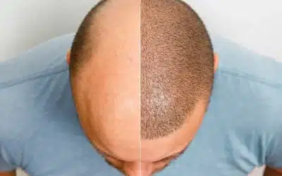 ¿Qué es un injerto capilar? El tratamiento definitivo contra la alopecia