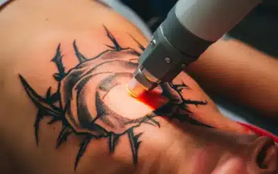 ¿Dónde eliminar tatuajes en Barcelona? Los 3 mejores sitios