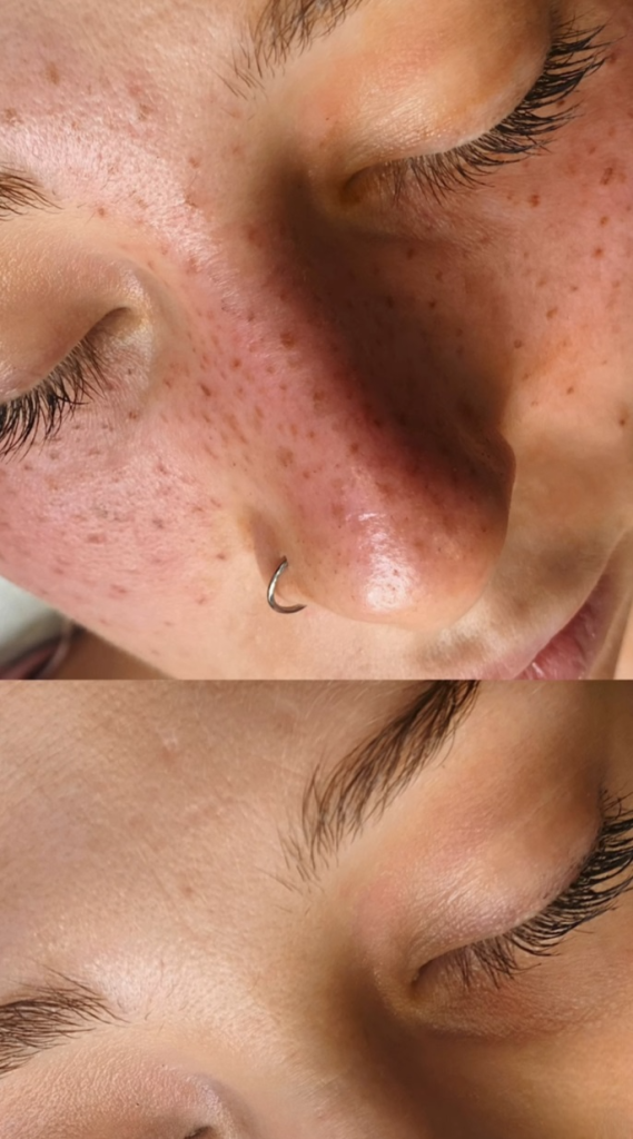 antes y despues freckling-Photoroom