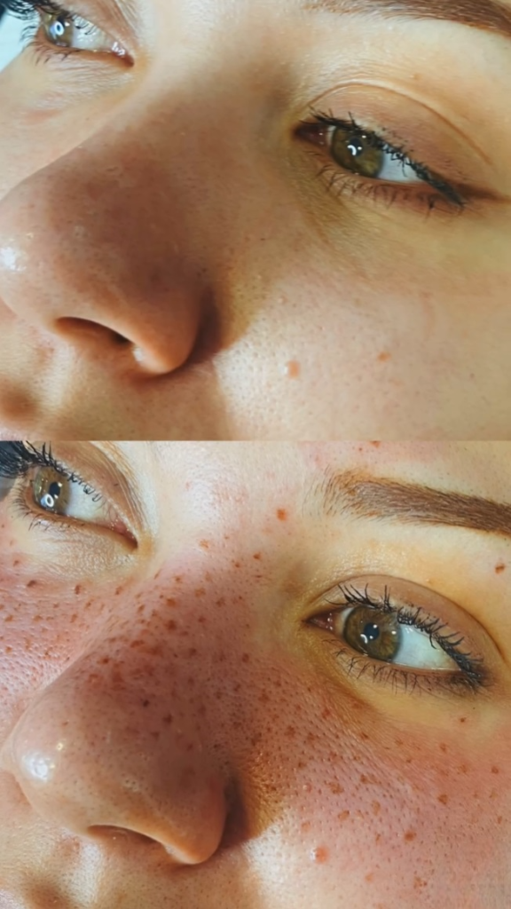 antes y despues freckling de pecas-Photoroom