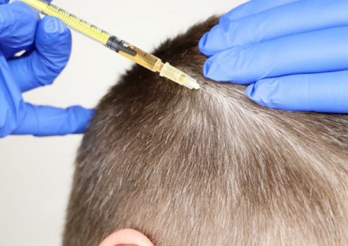 mesoterapia capilar barcelona