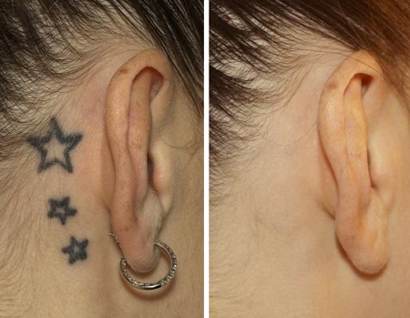 eliminar tatuajes cadiz