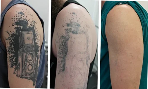 quitar tatuaje malaga